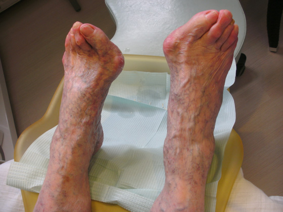 Oudere voet Pedicure Mieke