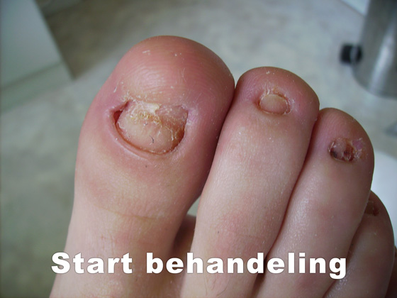 Nagelreparaties en nagelprotheses Pedicure Mieke