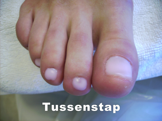 Nagelreparaties en nagelprotheses Pedicure Mieke