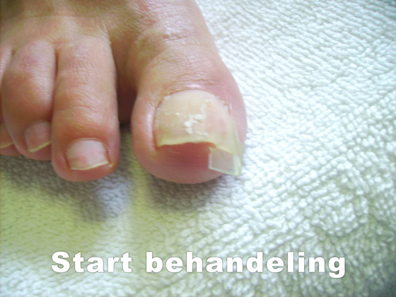 Nagelreparaties en nagelprotheses Pedicure Mieke