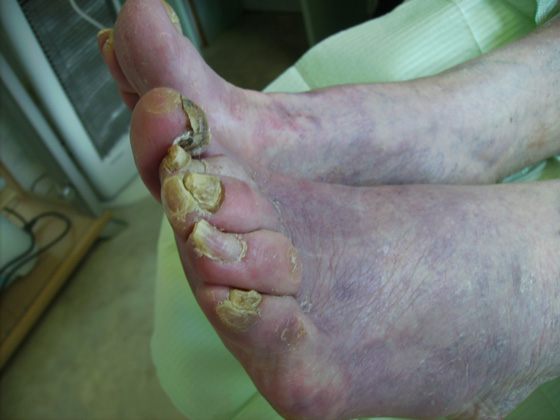 Verwaarloosde voet Pedicure Mieke