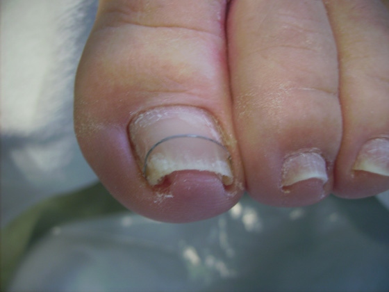 Nagelbeugel Pedicure Mieke